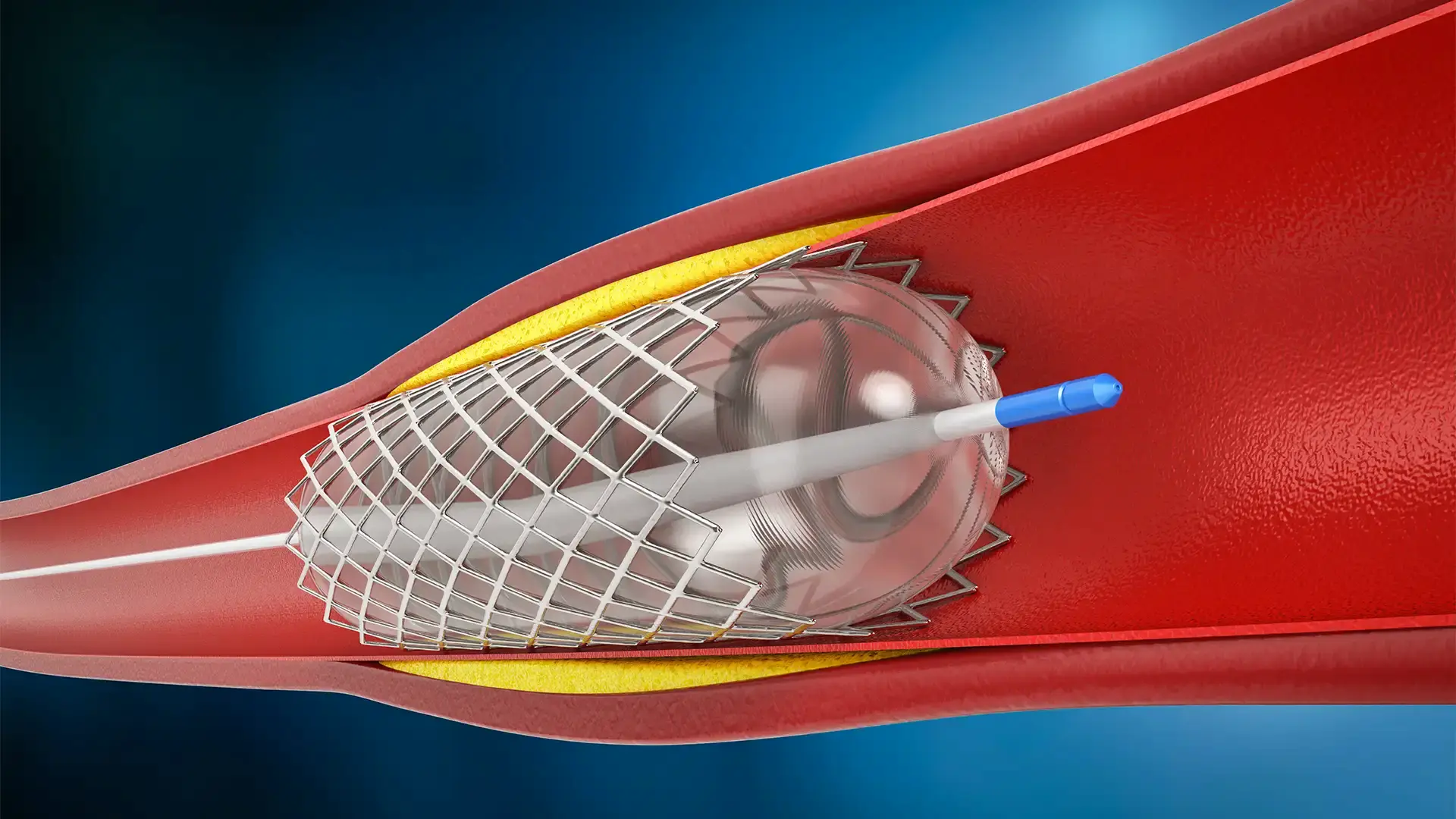 Stent Takılması Nasıl Gerçekleştirilir