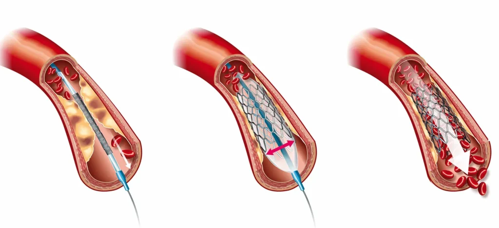 stent nedir ne işe yarar