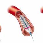 stent nedir ne işe yarar